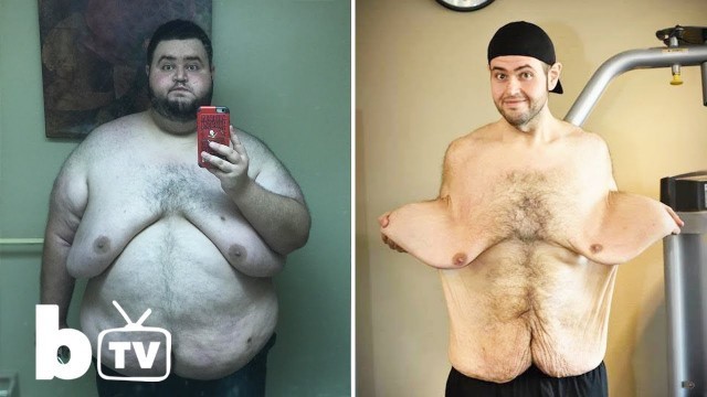 'My 300lbs Weight Loss Left Me With 13lbs Of Loose Skin'