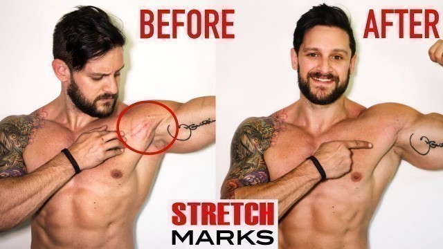 'STRETCH MARK REMOVAL | Best Medical To Home Remedies | Why You SHouldn\'t Be Ashamed! | Lex Fitness'